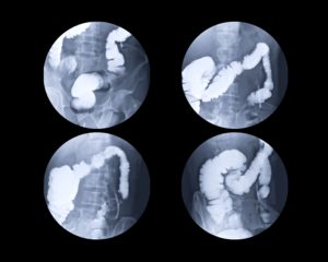What is a fluoroscopy? It's like an X-ray video of what is actively happening inside your body. This single contrast image shows a rectal injection of barium contrast into the colon and rectum, and X-ray films are obtained under fluoroscopic control.