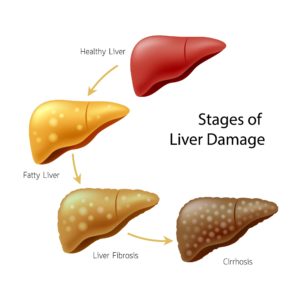 Stages of liver damage proceed from healthy liver to fatty liver to liver fibrosis, and then to cirrhosis.